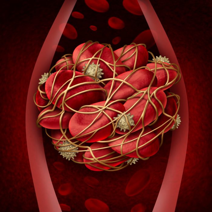Blood clot and thrombosis medical illustration concept as a group of human blood cells clumped together by sticky platelets and fibrin creating a blockage in an artery or vein as a health disorder symbol for circulatory system danger.